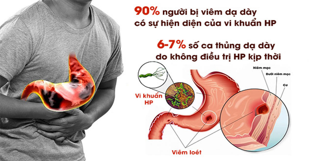 Viêm Dạ Dày Có Vi Khuẩn HP: Nguyên Nhân, Triệu Chứng Và Cách Phòng Ngừa